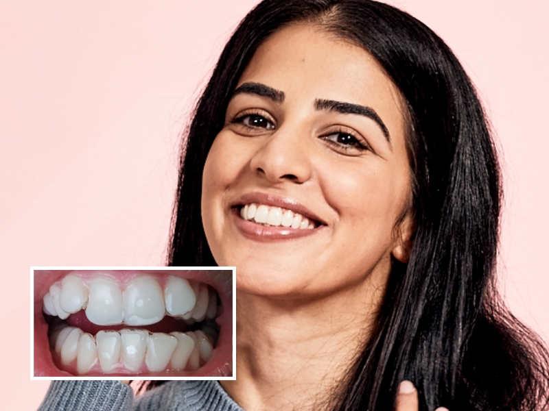 Photo avant-après d'une patiente DR SMILE ayant effectué un traitement par aligneur dentaire