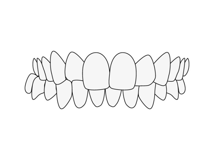 Malocclusion dentaire, occlusion croisée