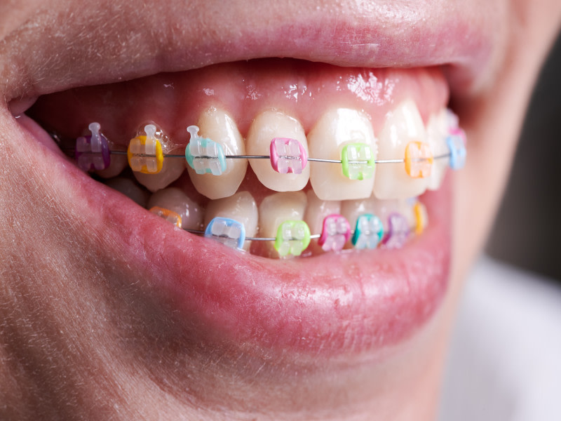 Gomas en la ortodoncia: ¿por qué se usan?