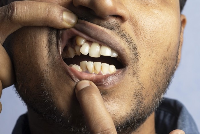 Krzywe zęby przyczyna brzydkiego zapachu z ust