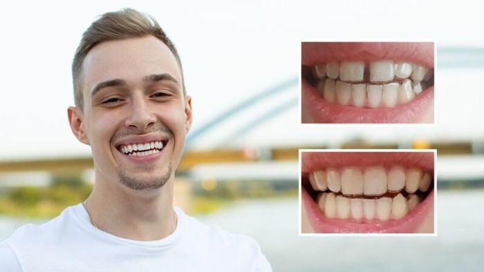 Résultats avant-après du port d'aligneurs DR SMILE pour combler l'espace entre deux dents - Jakub