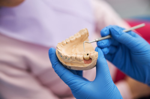 Próchnica zębów: jak ją rozpoznać i leczyć?