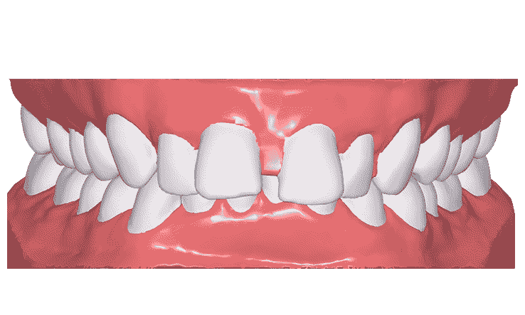 Gif montrant l'évolution de la dentition d'un patient DR SMILE avec le port d'aligneurs dentaires