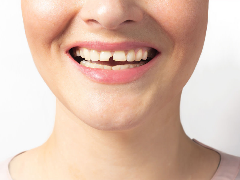 Sonrisa de una chica con un diente roto