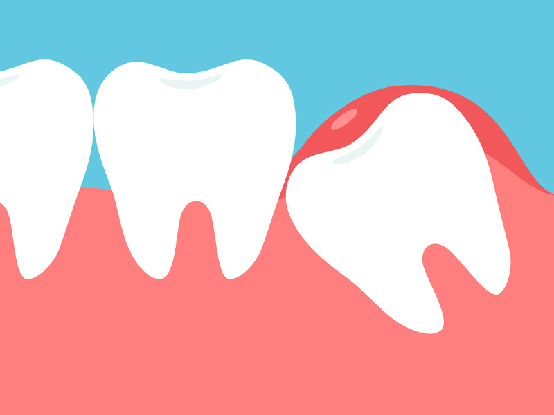 Drawing of wisdom teeth