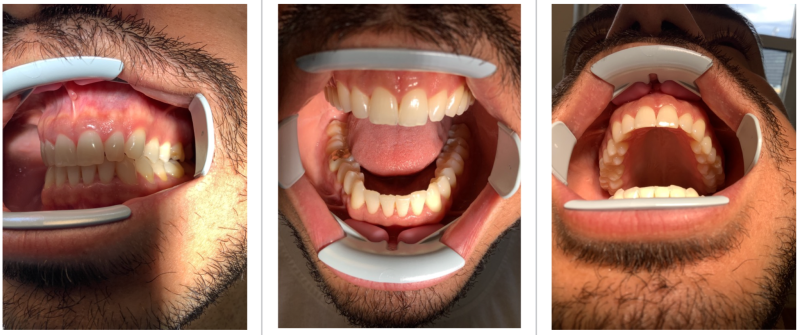 Étude de cas clinique : photo de la dentition du patient après son traitement par aligneurs dentaires (homme 33 ans, traitement 8 mois)