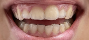 Testimonial DR SMILE Francesca prima