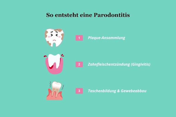 So entsteht eine Parodontitis