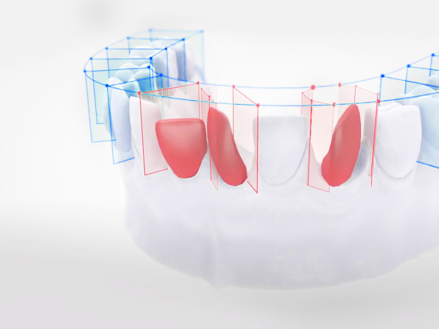 Malocclusione: Correggere i denti mal posizionati
