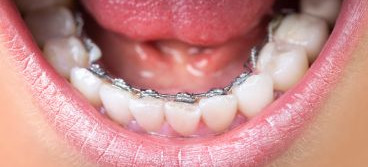 Price_LingualBraces_Desktop