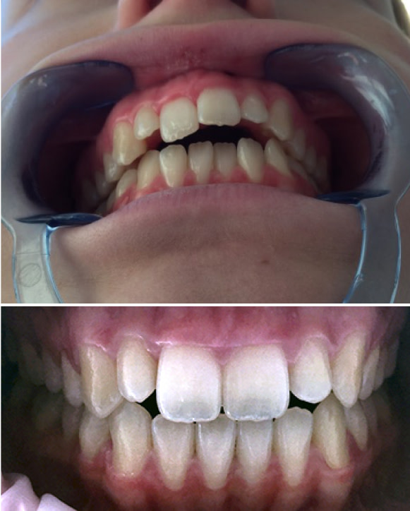 Résultats avant-après du traitement de supraclusion avec aligneurs dentaires