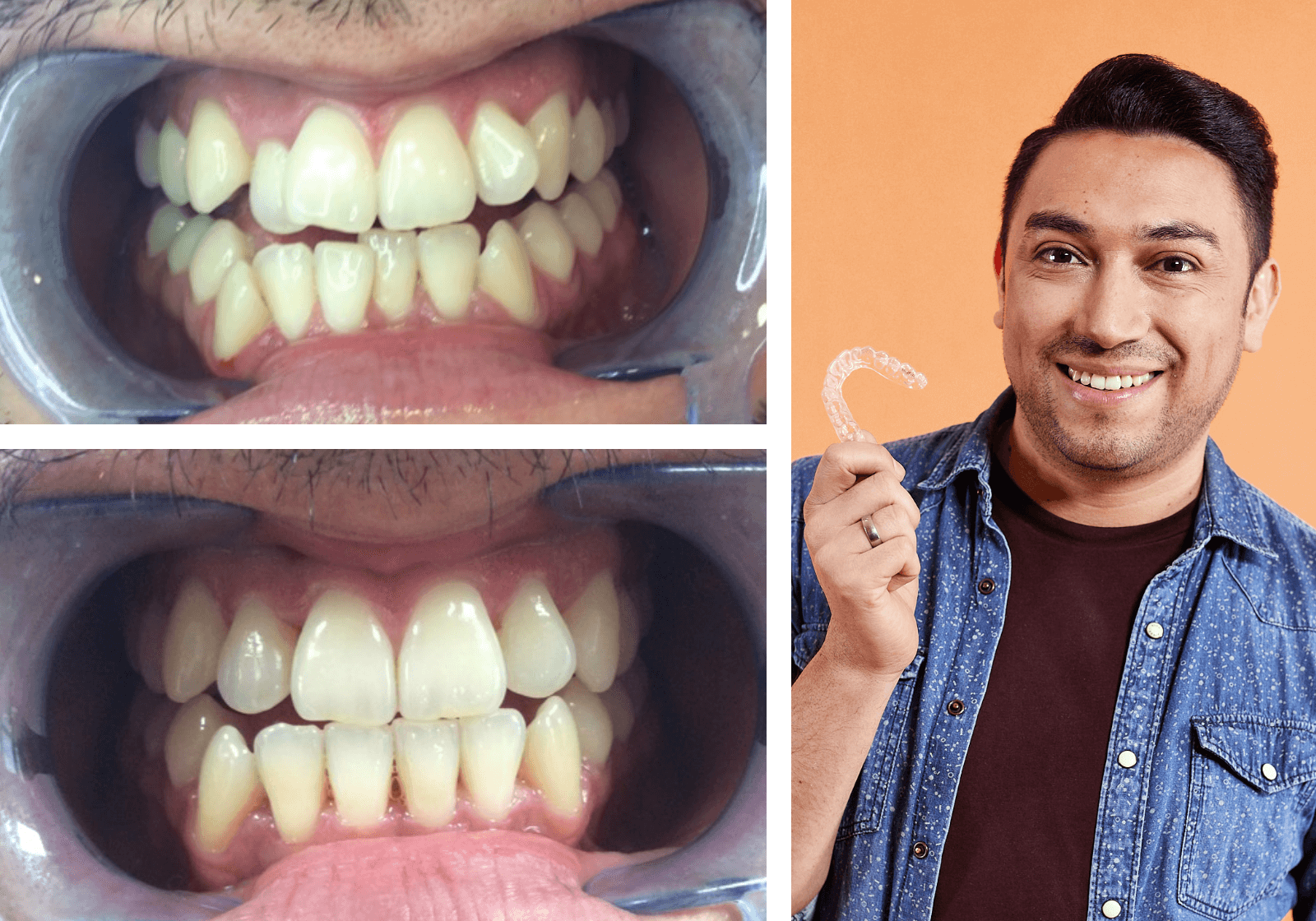 DR SMILE tandskena före efter