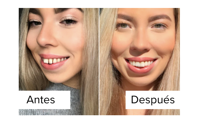 Alice-antes-despues-usar-alineadores