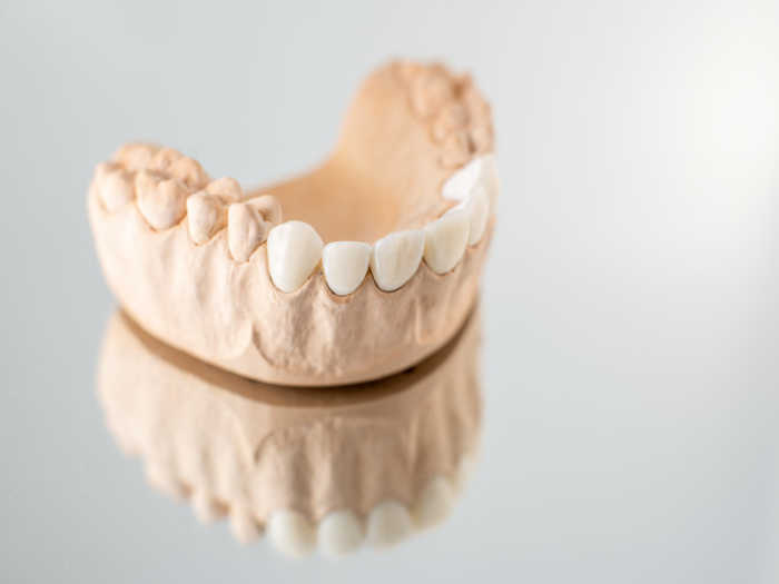 Modelo de mandíbula artificial con carillas