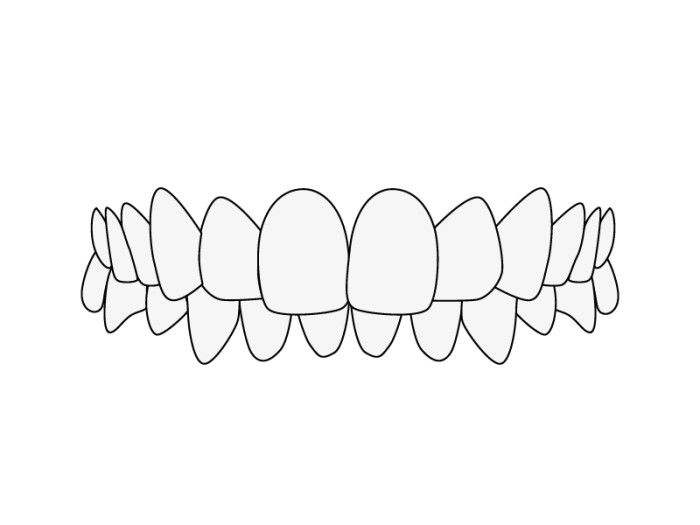 Misaligned Teeth: Deep bite