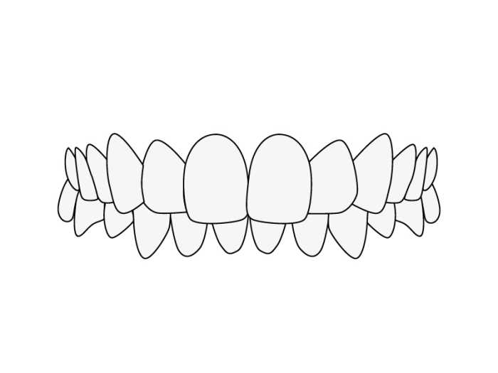 Feljustering av tänderna: djupt bett