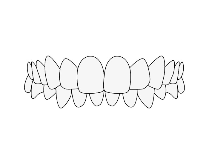Disallineamento dei denti: Morso profondo