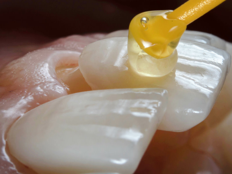 Nahaufnahme von Veneers, wie sie an einem Zahn angebracht werden