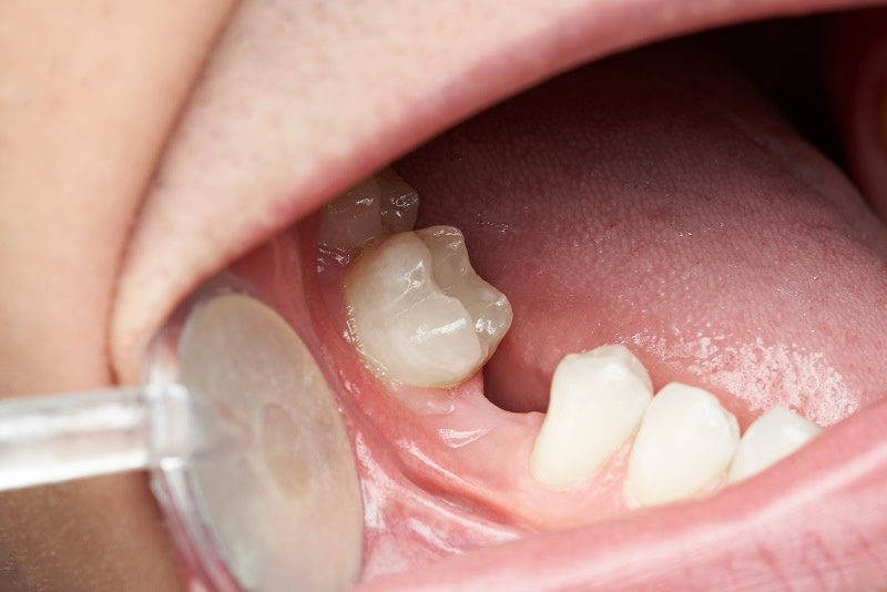 Zahnlücke durch die Nichtanlage von Zähnen im unteren Kiefer