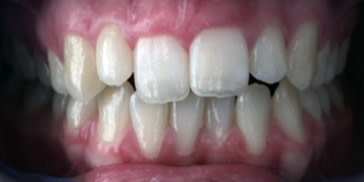 Malposition dentaire : Supraclusion
