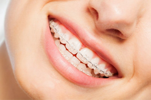 Brackets transparentes o invisibles: ¿qué son?