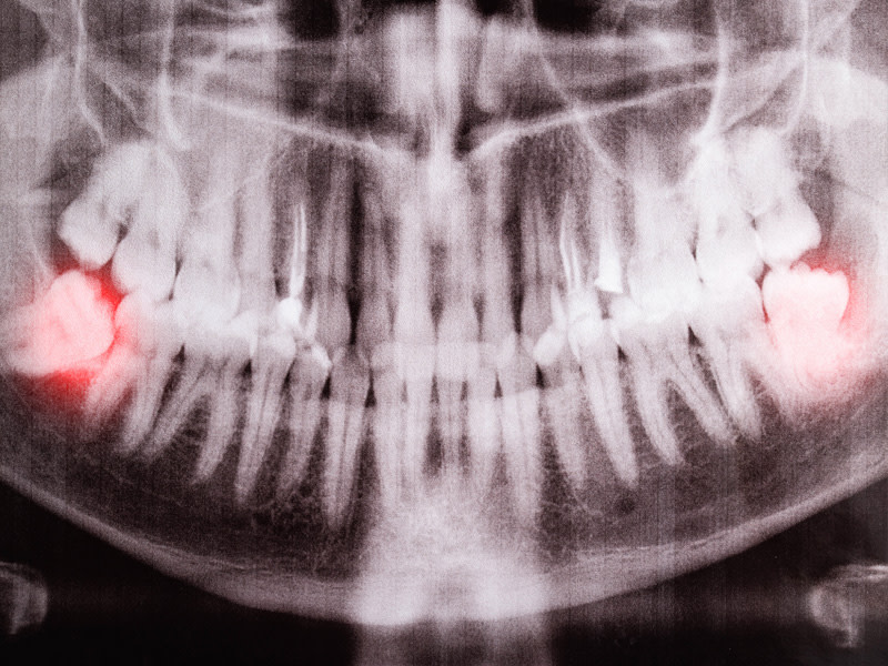 Radiografia de una boca