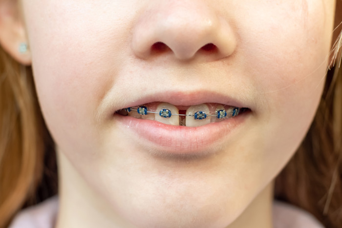 tooth gap