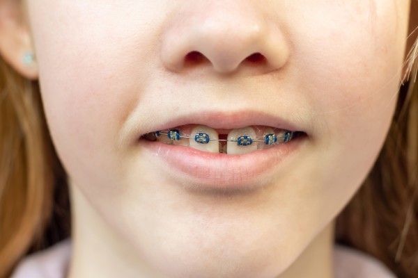 niña con diastema usando brackets