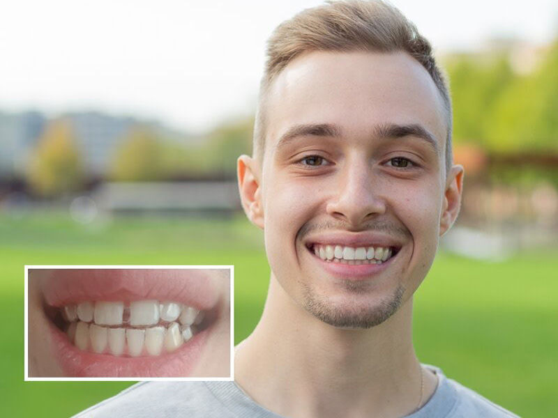 Before and After Diastema