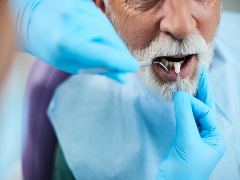 Prix des facettes dentaires - Tout ce que vous devez savoir - Top