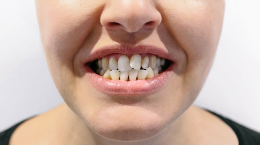 Weiblicher Mund mit Engstand der Zähne
