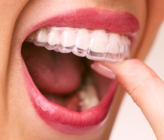 [CRO] Malocclusion LP 2Img 2 MOBILE