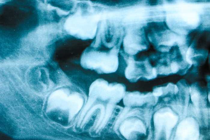 Retinierte Zähne Röntgenbild Zähne brechen nicht durch Weisheitszähne