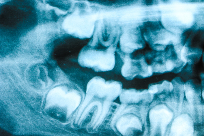 Retinierte Zähne Röntgenbild Zähne brechen nicht durch Weissheitszähne