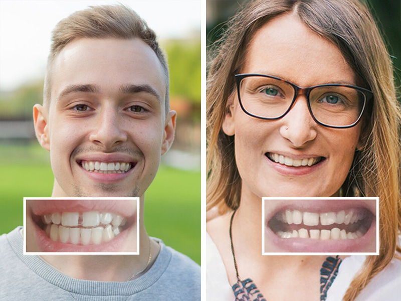 Imagen diastema antes y despues