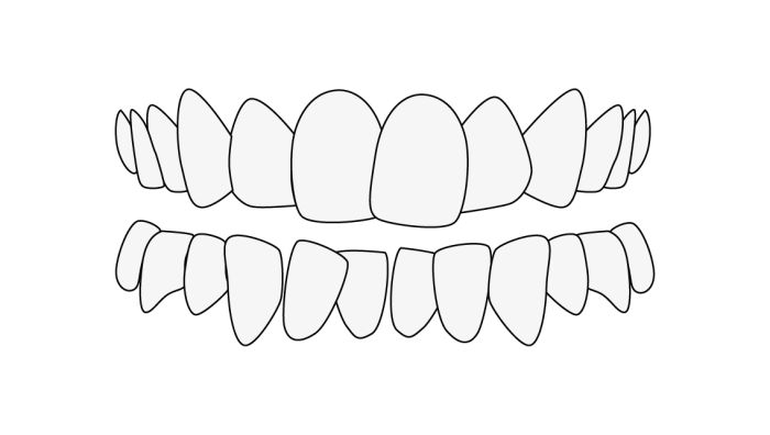 Malocclusion: Teeth misalignment crowding