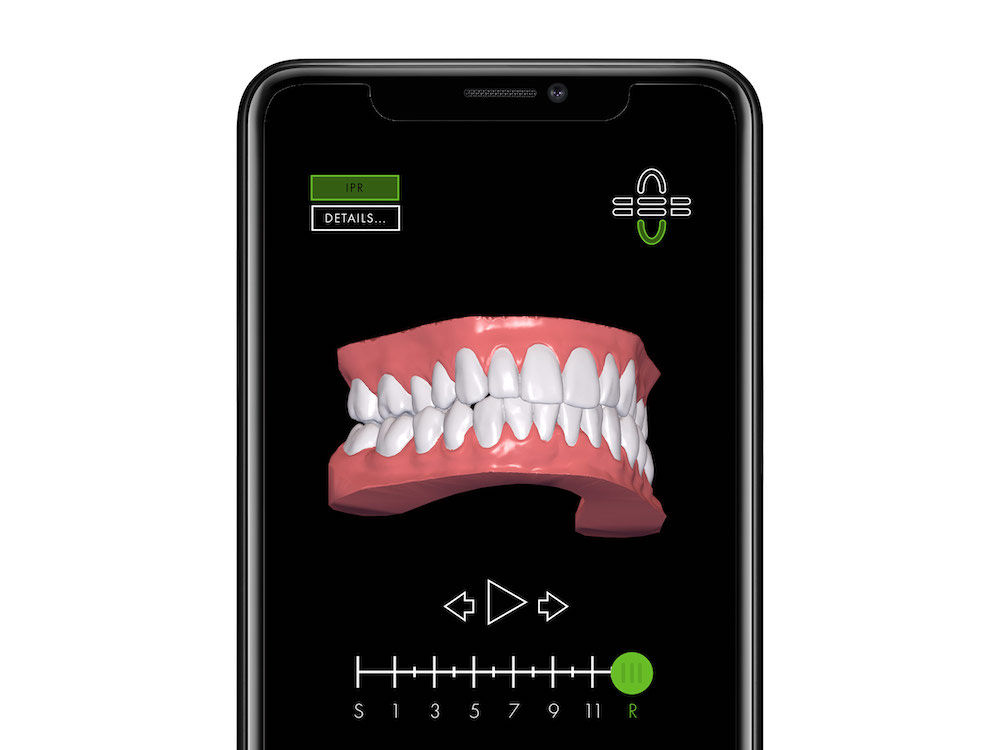 Simulation avant-aprÃ¨s d'un traitement par gouttiÃ¨res dentaires