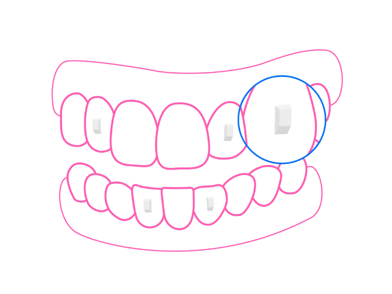 Ataches dentales: su papel en la ortodoncia invisible