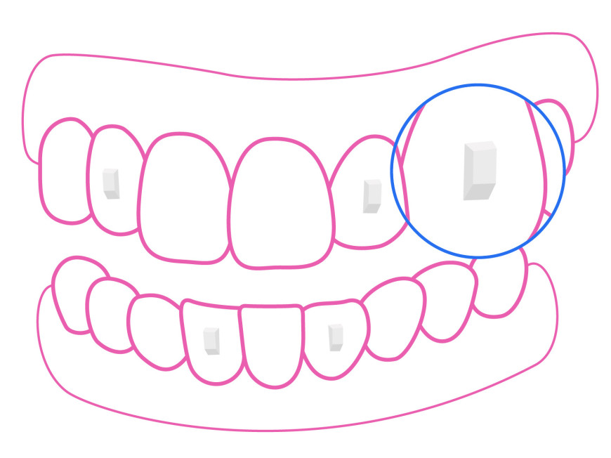 Illustration de taquets dentaires