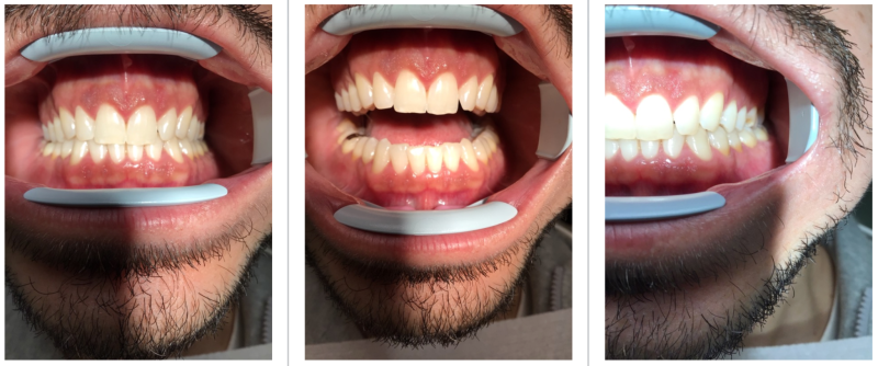 Dentition avant le traitement par aligneurs, cas d'étude clinique (homme, 33 ans)