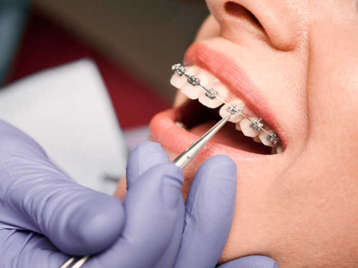 ortodoncista colocando ataches dentales
