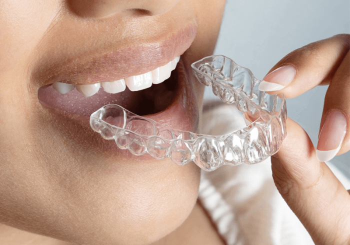 Aligners + 3d Mold