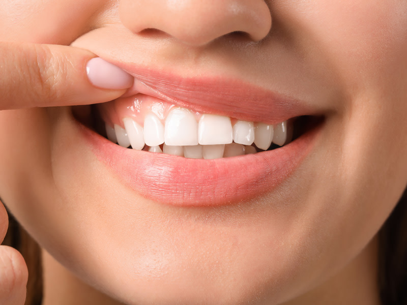 Esmalte dental: consejos para protegerlo
