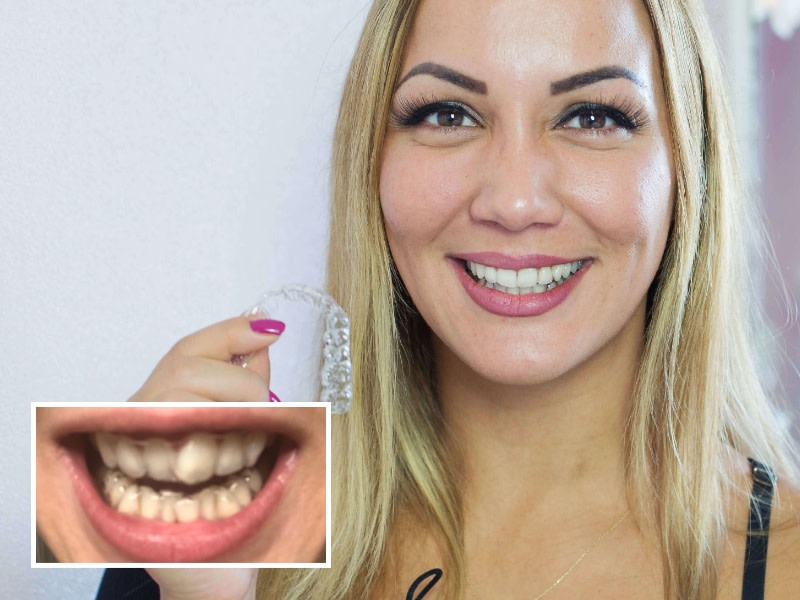 Résultats avant-après du port d'aligneurs DR SMILE lors d'un cas de chevauchement dentaire