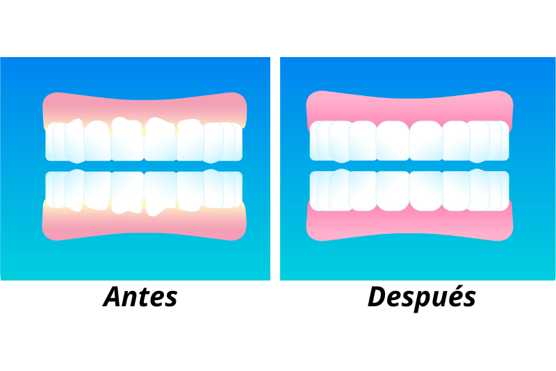 Curetaje dental antes y después