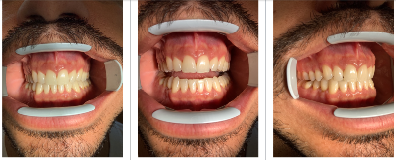Étude de cas clinique : photo de la dentition du patient après son traitement par aligneurs dentaires (homme 33 ans, traitement 8 mois)