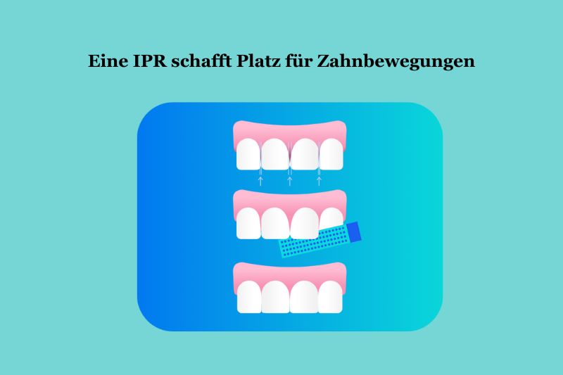 Eine IPR schafft platz für Zahnbewegungen
