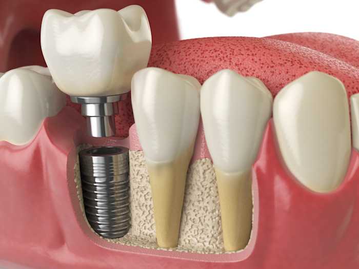 Stilllife-Medical-implant-implantat_seo-blog_v1_800x600_all_12__