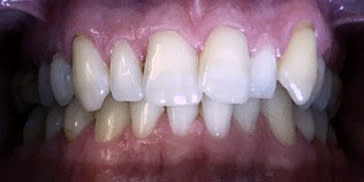 Foto de apiñamiento dental