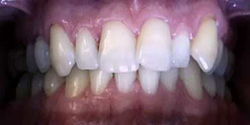 Crowding of the teeth - misaligned teeth